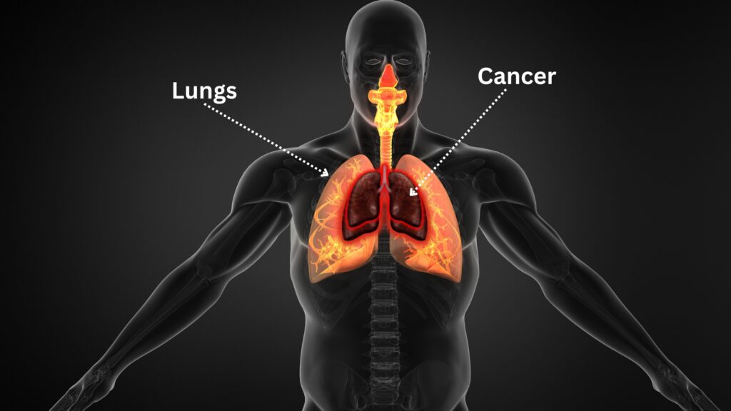 world lung cancer day 2024